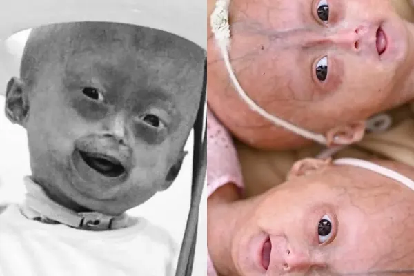 Elis, influencer mirim, morre aos 5 anos após luta contra progéria