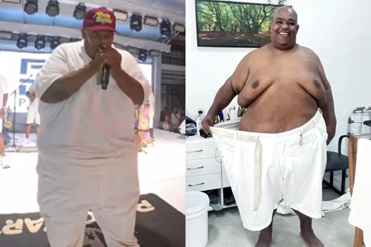 Luciano Babu passa por bariátrica após perder 108 kg